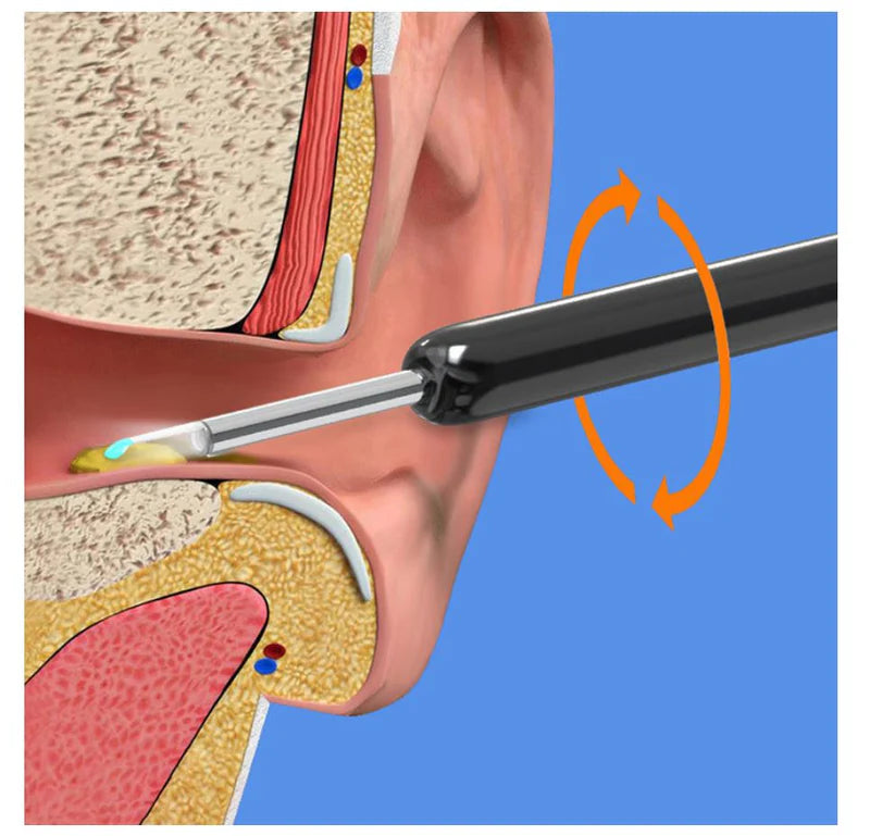Smart Visual Earwax Removal Tool